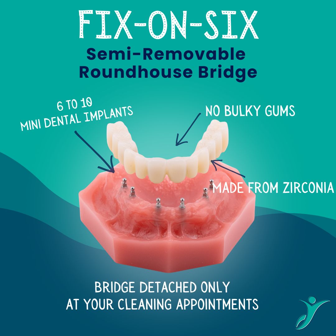 Fixed Bridges in Naples, FL