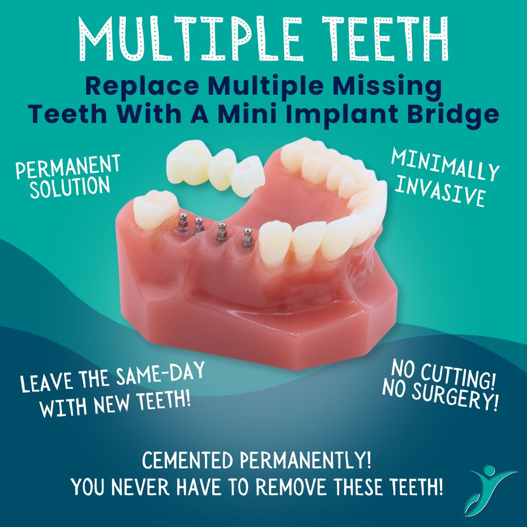 Multiple Tooth Replacement in Naples, FL