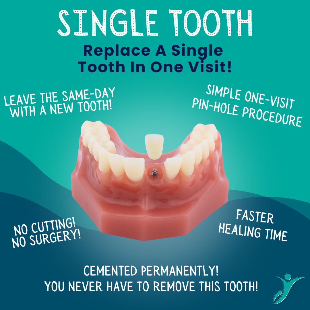 Single Tooth Replacement in Naples, FL