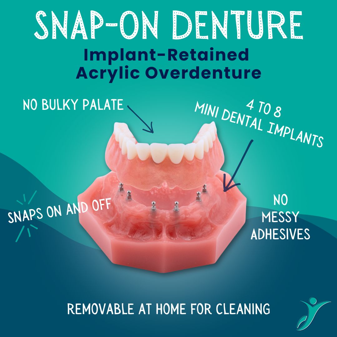 Snap-On Denture in Naples, FL